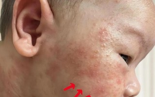 新生儿脸上小红点是何原因？
