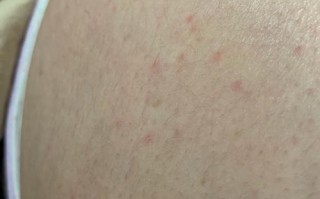 怀孕期间出现皮下小红点，是孕期正常现象还是需警惕的健康信号？