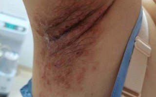 孕期感染单纯疱疹病毒