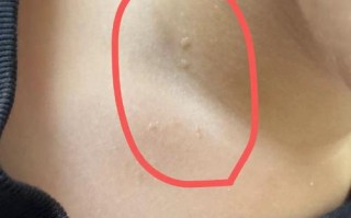 儿童脖子上长疙瘩是何原因？