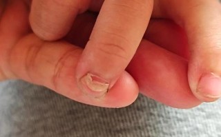 新生儿手指甲旁边掉皮是正常现象吗？需要担心感染或营养不良吗？
