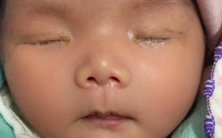 新生儿眼屎多睁不开眼