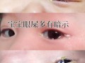 新生儿一只眼睛眼屎多又黄粘稠怎么办？