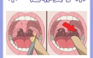 儿童腺样体手术具体怎么做？需要全麻吗？术后恢复要注意什么？