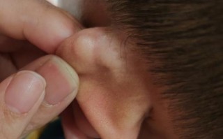 新生儿耳朵边有个小包