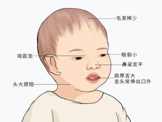 新生儿甲低症状有哪些？-第2张图片-中州医学会