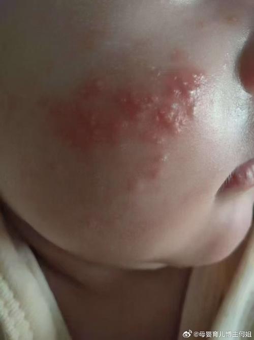 新生儿脸小红点带白头是啥？-第2张图片-中州医学会