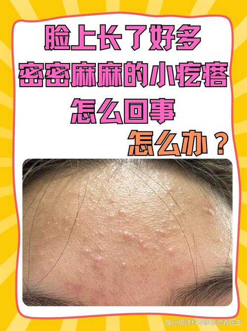 孕期长粉刺怎么办？-第2张图片-中州医学会