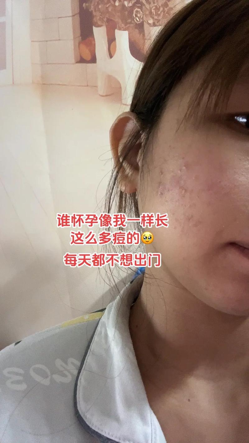 孕期长粉刺怎么办？-第1张图片-中州医学会