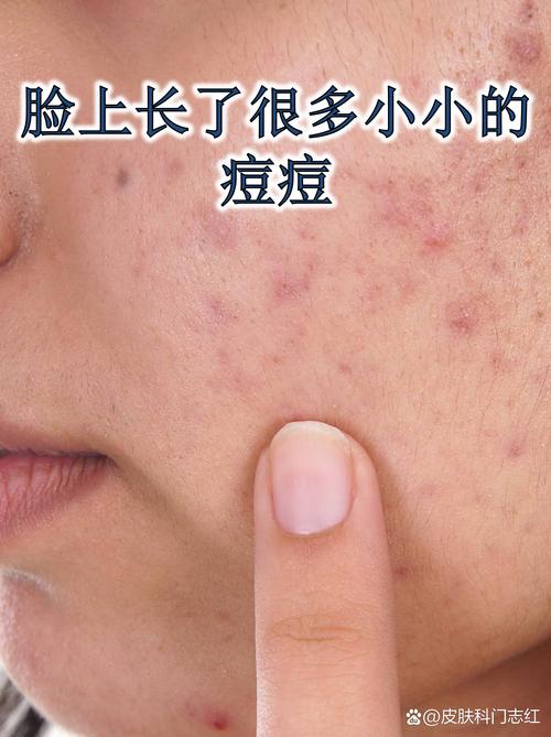 孕期长粉刺怎么办？-第3张图片-中州医学会