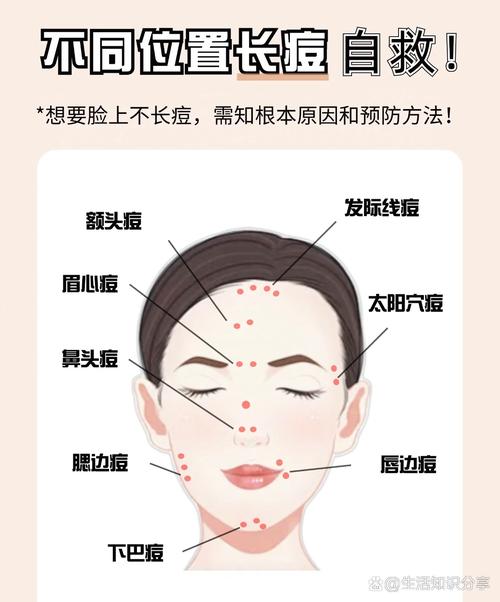 孕期额头长痘是激素变化还是其他原因？-第3张图片-中州医学会