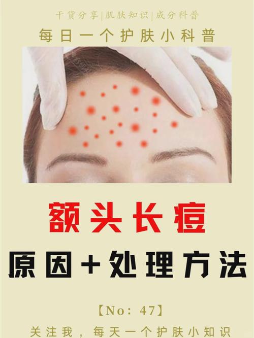 孕期额头长痘是激素变化还是其他原因？-第1张图片-中州医学会