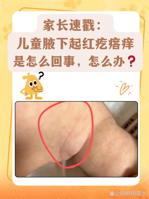 儿童红疙瘩痒是过敏还是皮肤病？-第3张图片-中州医学会