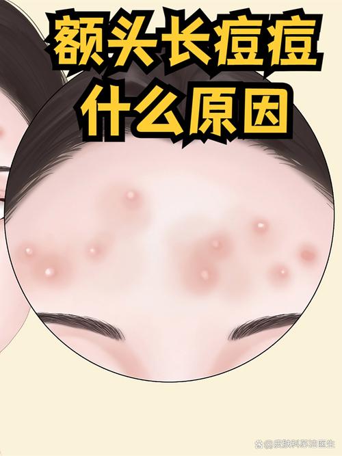 孕期额头痘，是激素惹的祸？-第1张图片-中州医学会