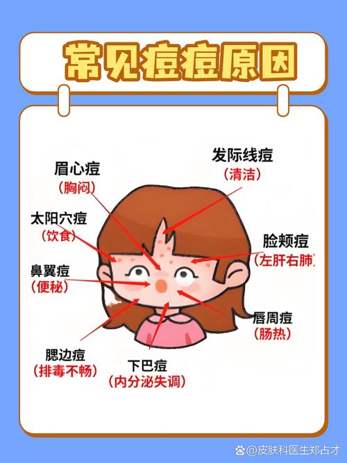 孕期额头痘，是激素惹的祸？-第3张图片-中州医学会