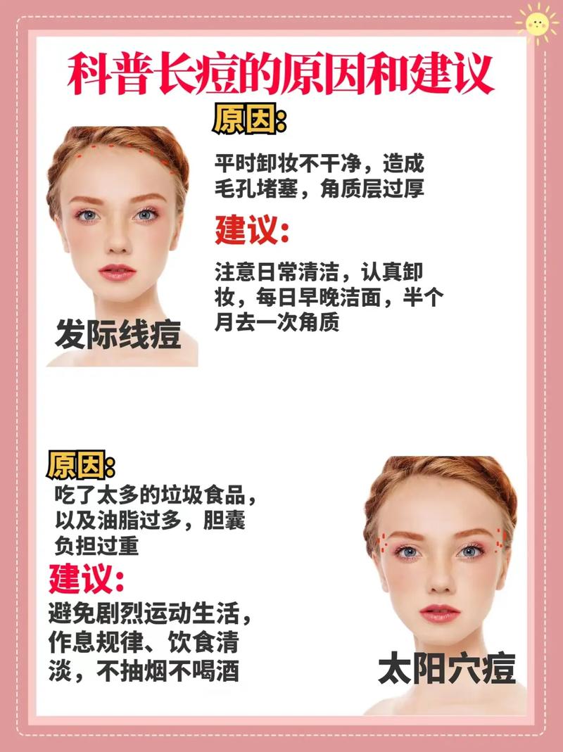 孕期额头痘，是激素惹的祸？-第2张图片-中州医学会