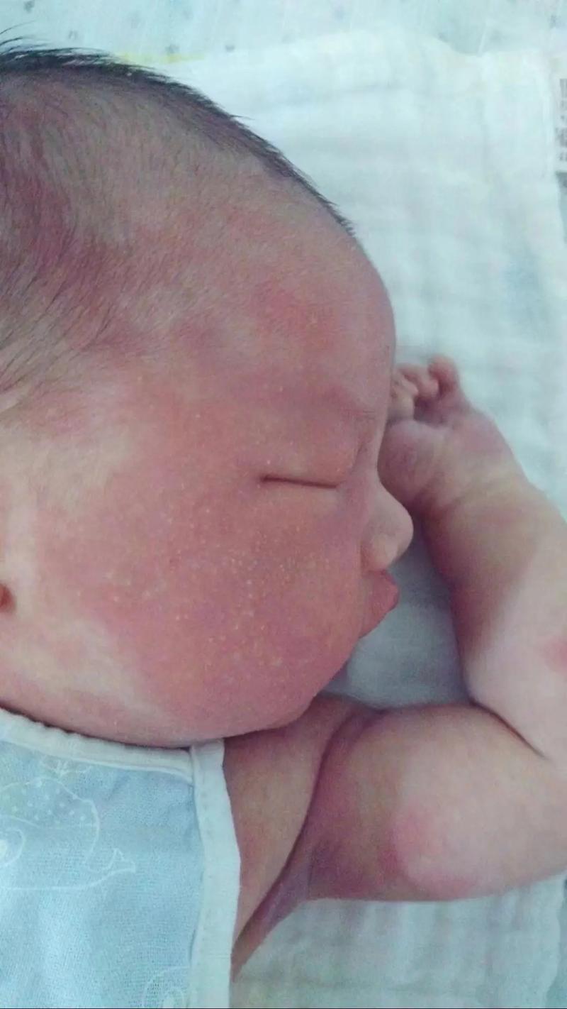 新生儿脸上小红点是何原因?-第2张图片-中州医学会 新生儿脸上小红点是何原因?-第2张图片-中州医学会