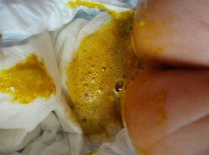 新生儿泡沫便是何原因？-第2张图片-中州医学会