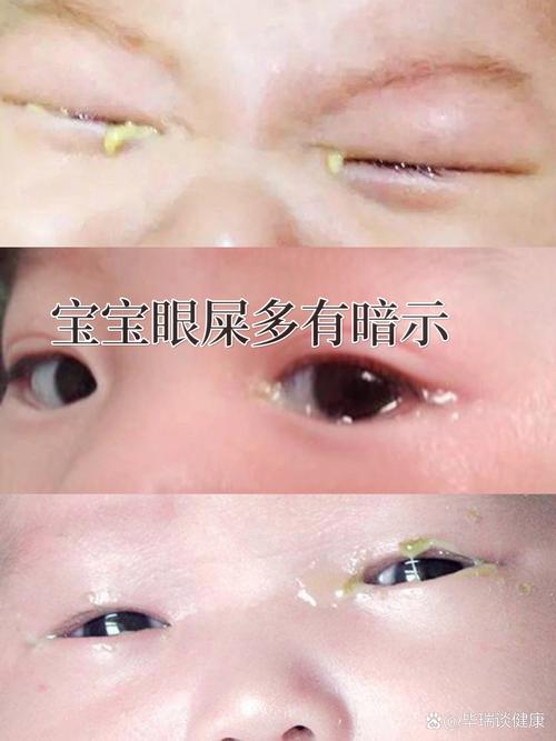 新生儿一只眼睛眼屎多又黄粘稠怎么办？-第1张图片-中州医学会