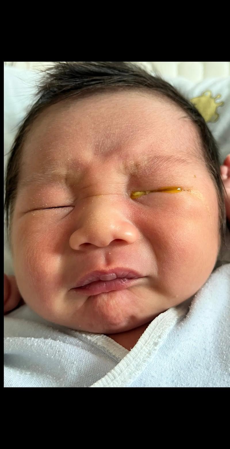 新生儿一只眼睛眼屎多又黄粘稠怎么办？-第2张图片-中州医学会