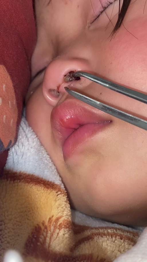 新生儿鼻屎怎么安全弄出来？-第3张图片-中州医学会