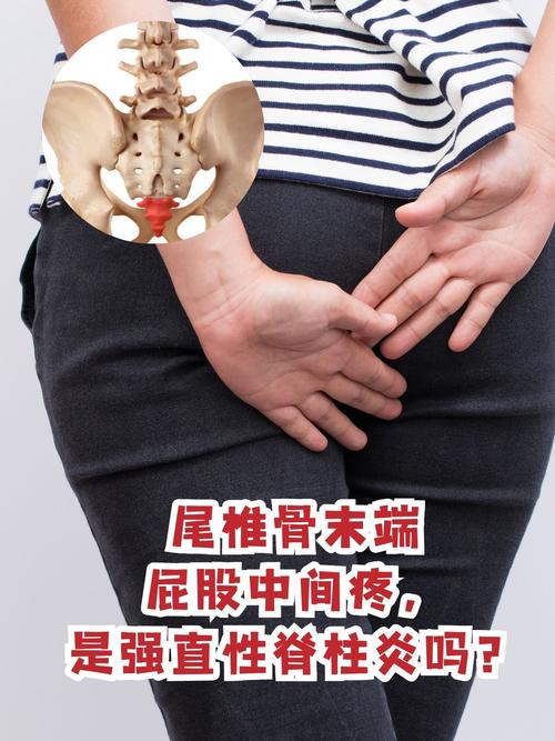 孕期尾椎疼，是胎儿压迫还是身体缺钙？-第3张图片-中州医学会