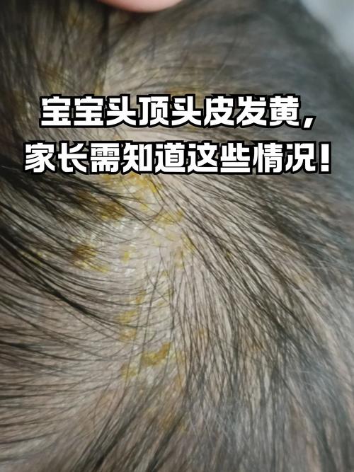 新生儿头发稀黄是缺营养吗？-第1张图片-中州医学会