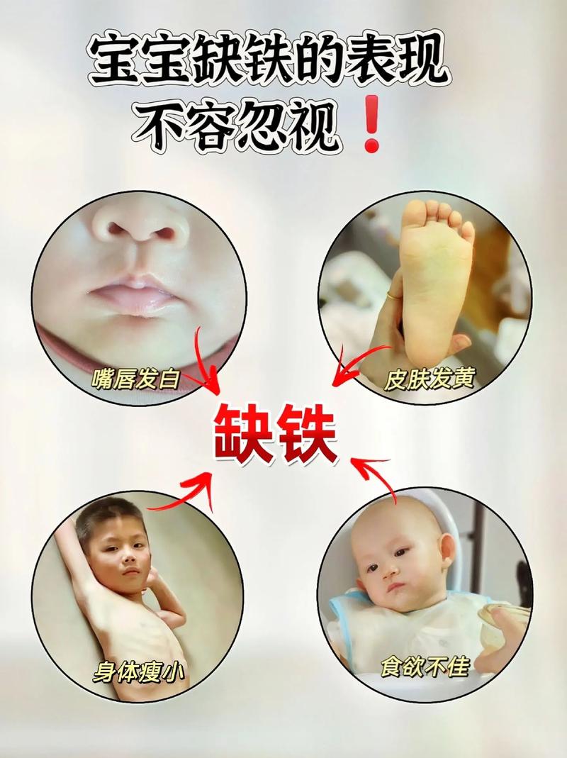 新生儿缺锌有哪些表现症状？-第2张图片-中州医学会