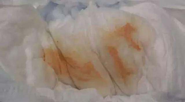 新生儿下面白色分泌物正常吗？-第1张图片-中州医学会