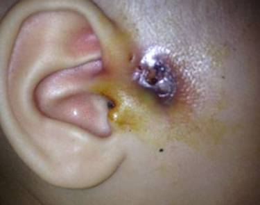 新生儿下面白色分泌物正常吗？-第3张图片-中州医学会