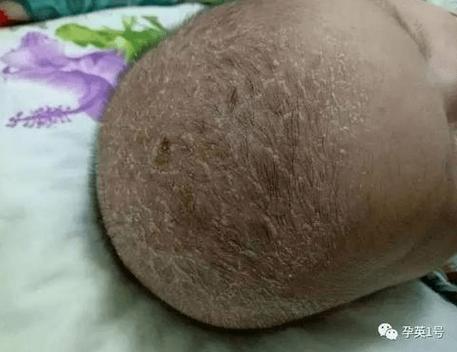 新生儿下面白色分泌物正常吗？-第2张图片-中州医学会