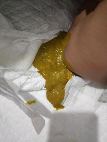 10岁儿童一周一次大便正常吗？-第3张图片-中州医学会