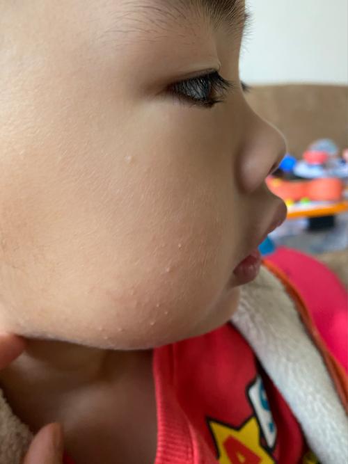 儿童脸上密密麻麻小疙瘩是啥原因？-第2张图片-中州医学会