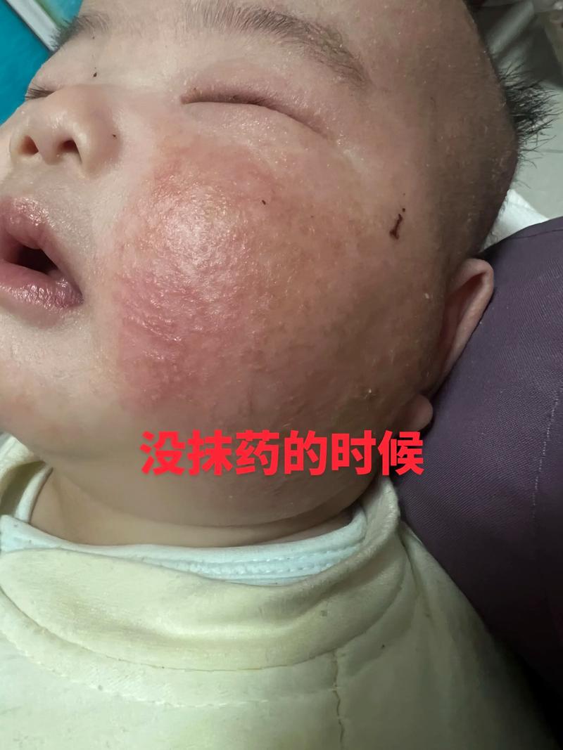 儿童脸上密密麻麻小疙瘩是啥原因？-第1张图片-中州医学会