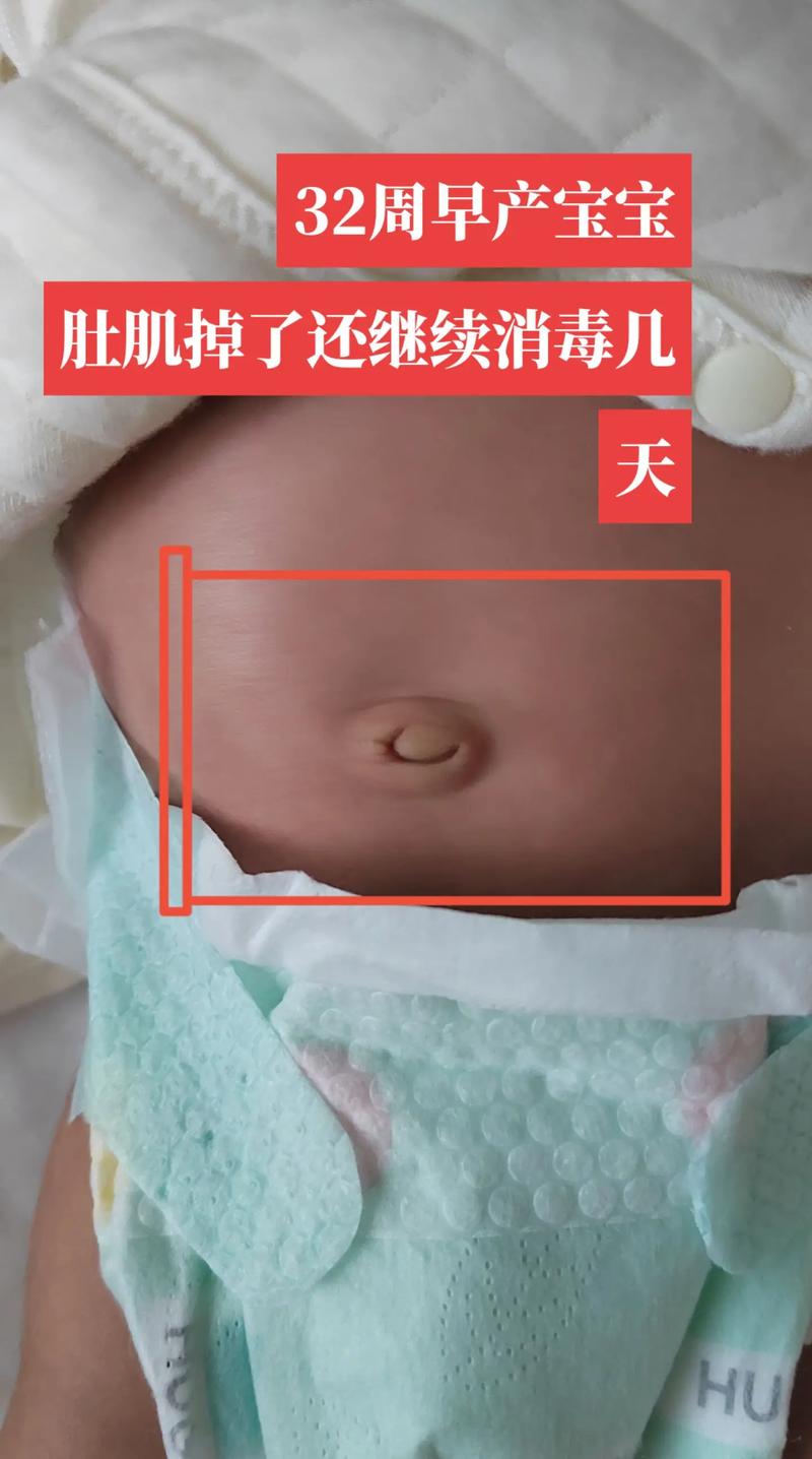 新生儿肚脐脱落后还需消毒吗？-第1张图片-中州医学会