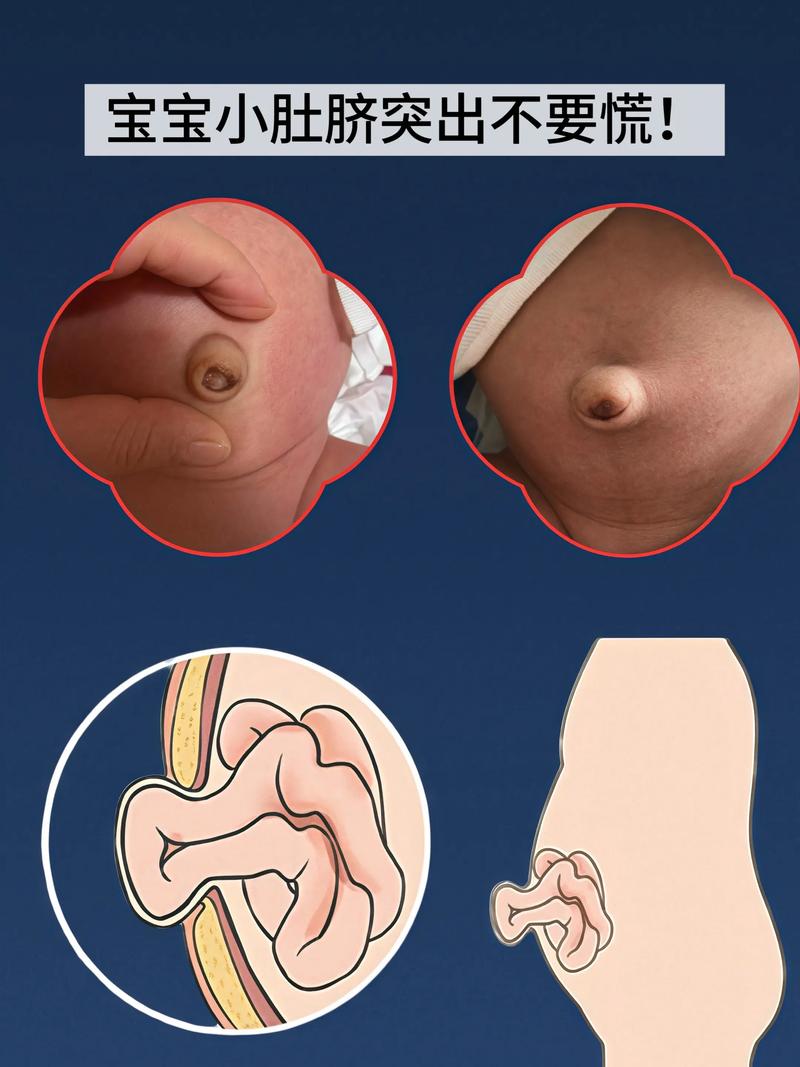 新生儿肚脐内凹陷，是何原因？-第2张图片-中州医学会