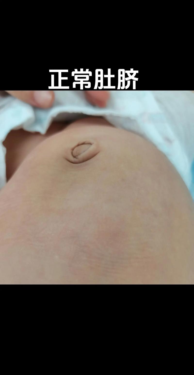 新生儿肚脐内凹陷，是何原因？-第1张图片-中州医学会