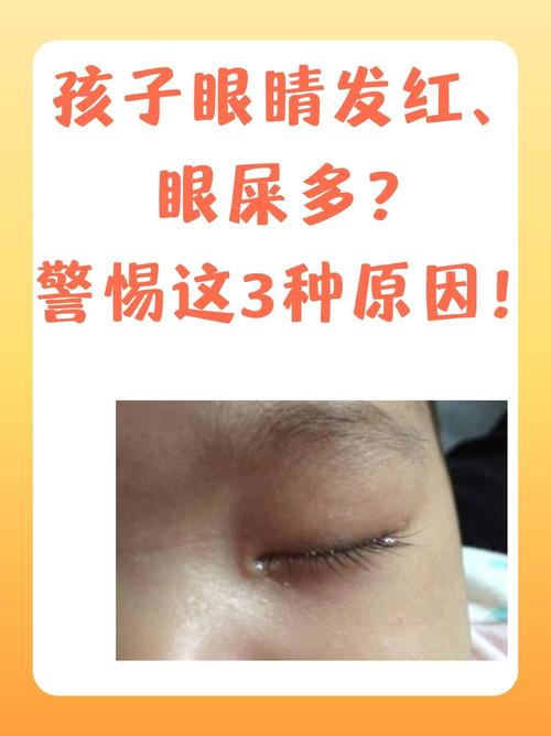 新生儿左眼流泪眼屎怎么办？-第1张图片-中州医学会