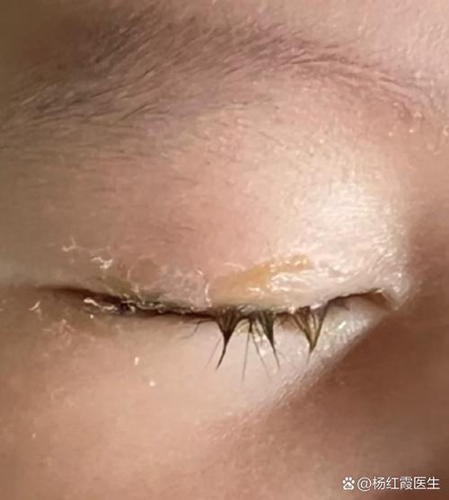 新生儿左眼流泪眼屎怎么办？-第2张图片-中州医学会