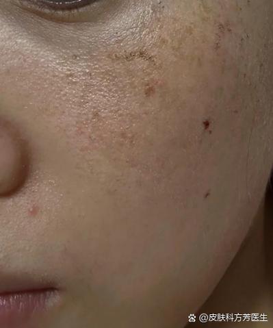 孕期脸斑多怎么办?-第3张图片-中州医学会 孕期脸斑多怎么办?-第3张图片-中州医学会
