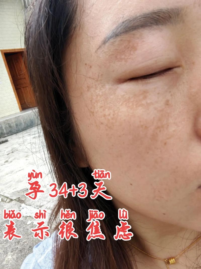 孕期脸斑多怎么办?-第1张图片-中州医学会 孕期脸斑多怎么办?-第1张图片-中州医学会