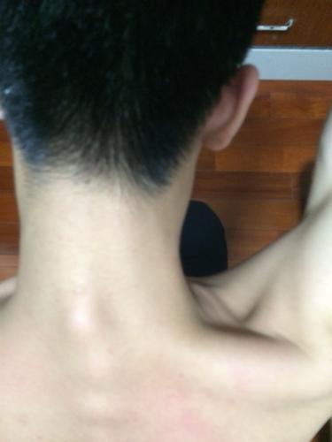 儿童脖子后骨头突出是正常现象吗？-第3张图片-中州医学会