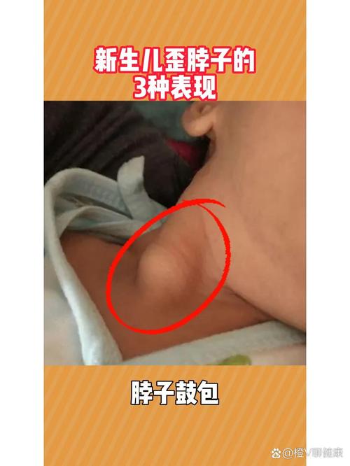 新生儿甲低症状有哪些?-第3张图片-中州医学会 新生儿甲低症状有哪些?-第3张图片-中州医学会