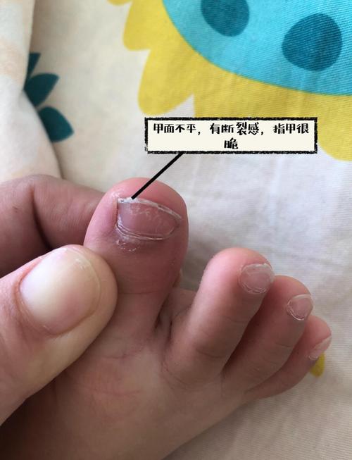 新生儿脚趾甲长肉里咋办？-第1张图片-中州医学会