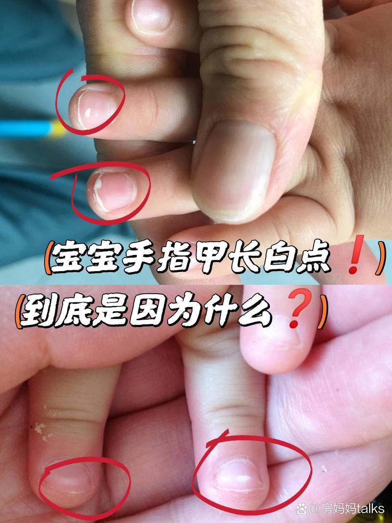 儿童指甲白点是缺钙还是生病了？-第1张图片-中州医学会