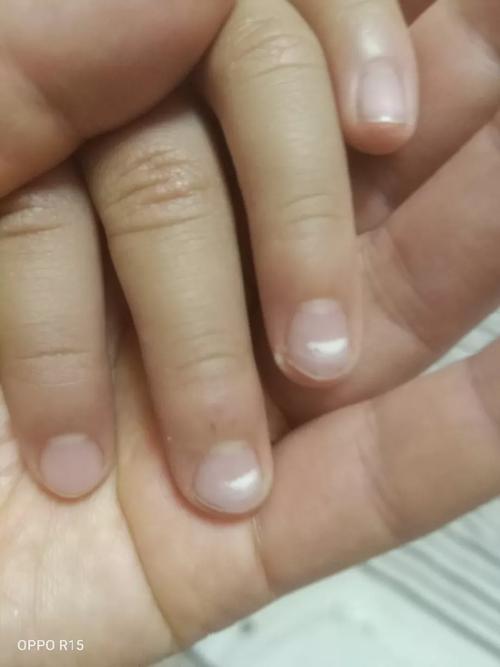 儿童指甲白点是缺钙还是生病了？-第3张图片-中州医学会
