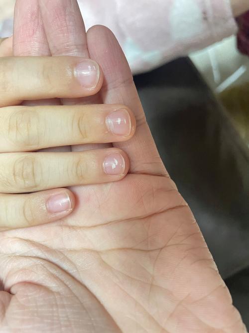 儿童指甲白点是缺钙还是生病了？-第2张图片-中州医学会