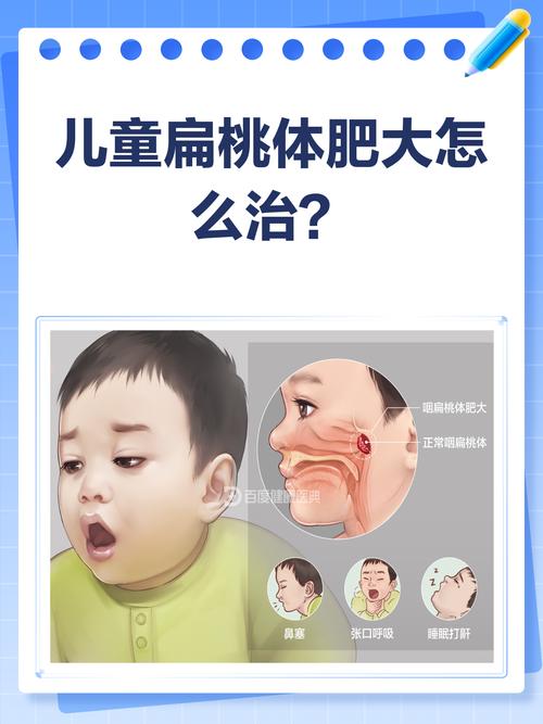 儿童扁桃体肥大，最佳治疗方法是什么？-第3张图片-中州医学会