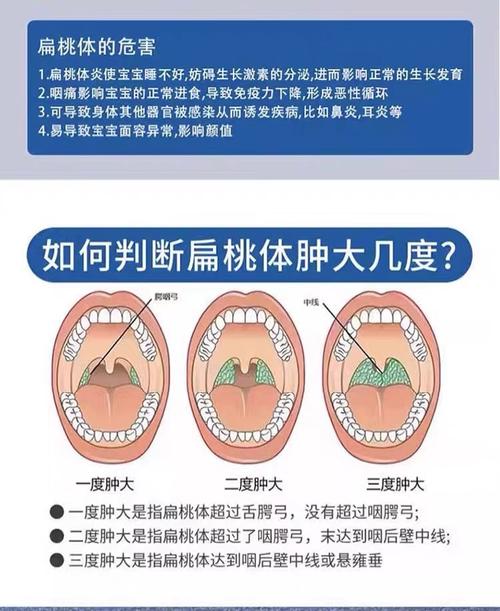 儿童扁桃体肥大，最佳治疗方法是什么？-第1张图片-中州医学会