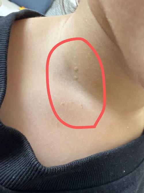 儿童脖子上长疙瘩是何原因？-第1张图片-中州医学会